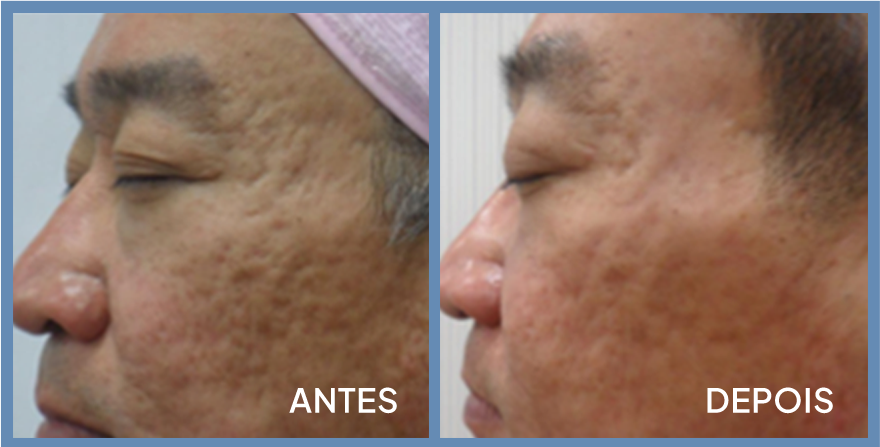 Antes e depois — cicatrizes de acne