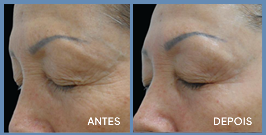 Antes e depois — rugas periorbitais