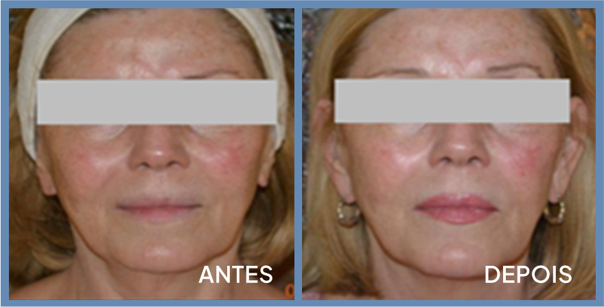 Antes e depois — RFMU contorno facial