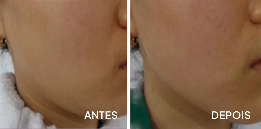 Antes e depois — RFMU lifting e contorno mandibular