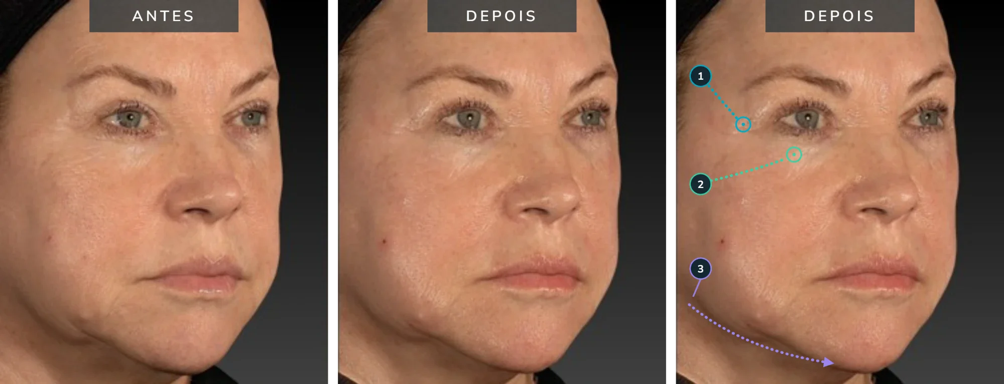 Antes e depois — caso 01: região periocular e contorno mandibular, 63 anos, pós 7 dias