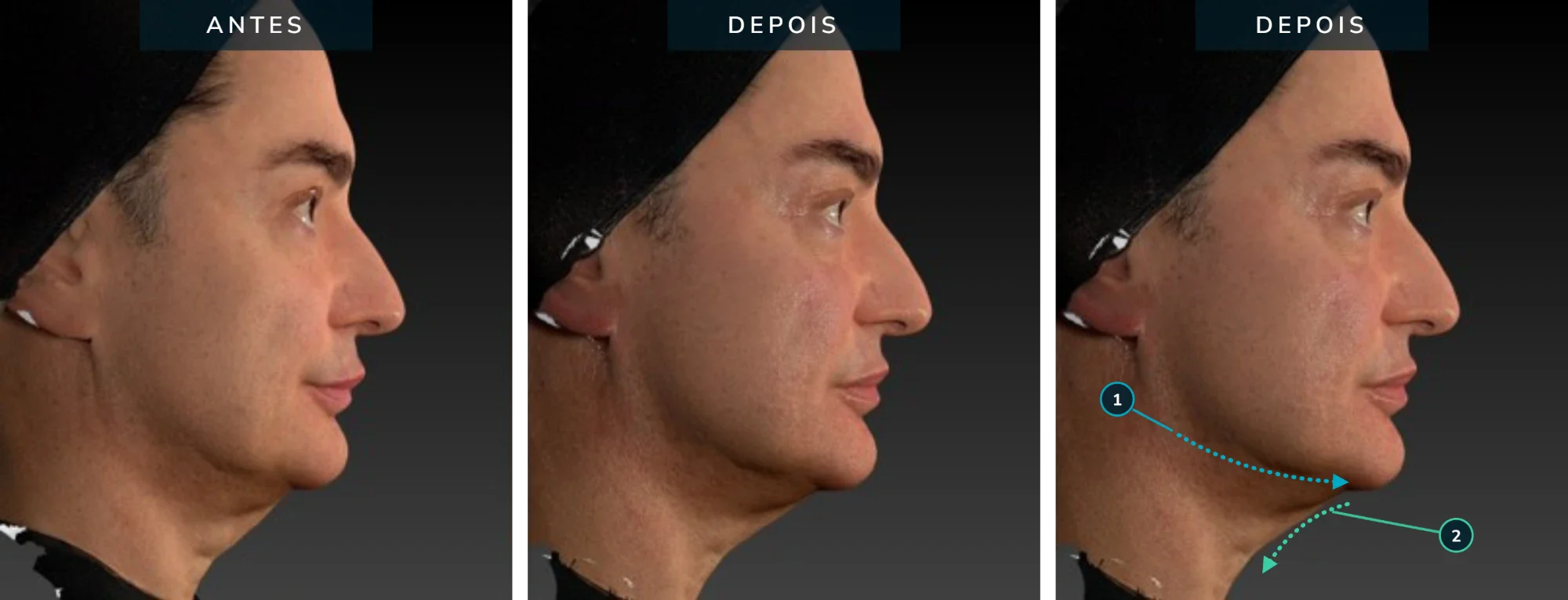 Antes e depois — caso 02: contorno mandibular e região submentoniana, 59 anos, pós imediato