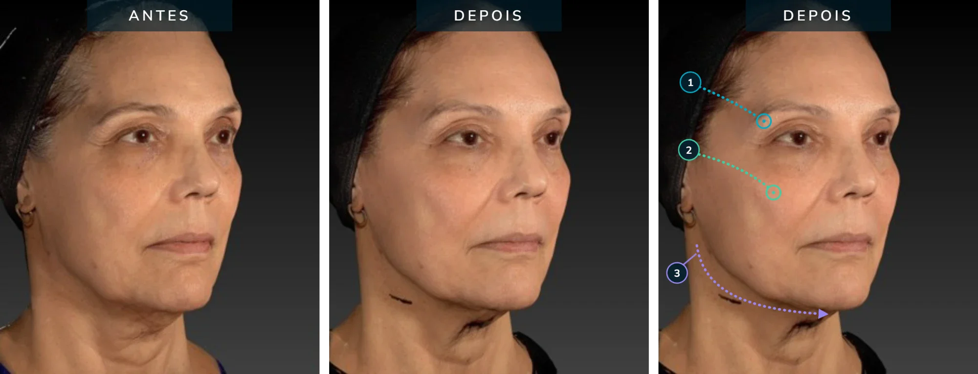 Antes e depois — caso 03: sustentação facial e contorno mandibular, 68 anos, pós 15 dias