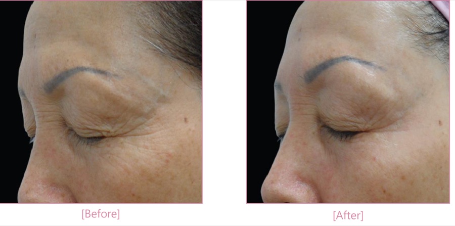 Antes e depois — rugas periorbitais