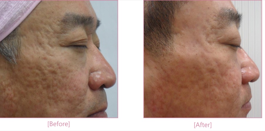 Antes e depois — cicatriz de acne