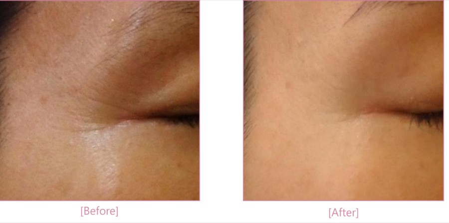 Antes e depois — pés de galinha