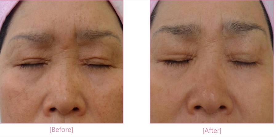 Antes e depois — flacidez / ptose