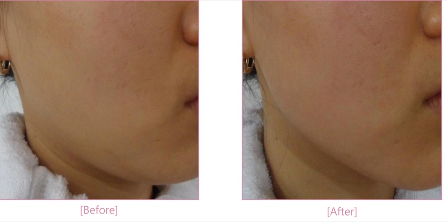Antes e depois — lifting