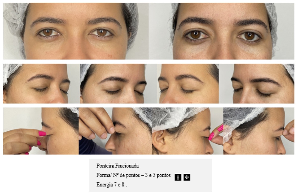 Antes e depois — pálpebras com plasma fracionado