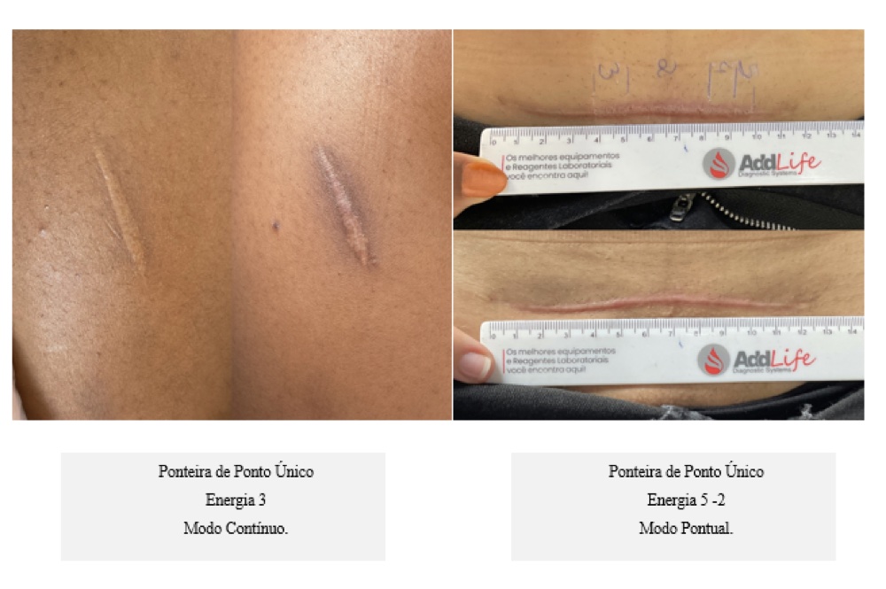Antes e depois — cicatriz corporal com ponto único