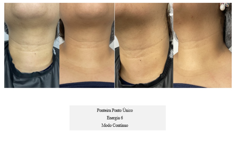 Antes e depois — pescoço com ponto único