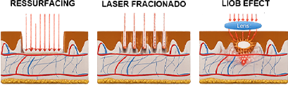 Comparativo: ressurfacing, laser fracionado e LIOB Effect