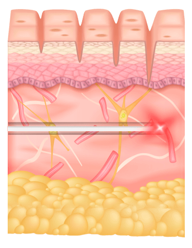 Ilustração das camadas da pele com a microfibra do laser subdérmico Ultralift em atuação